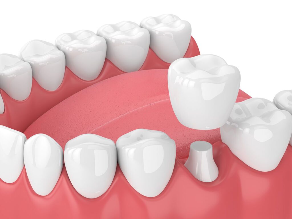 dental crowns in Waco, TX